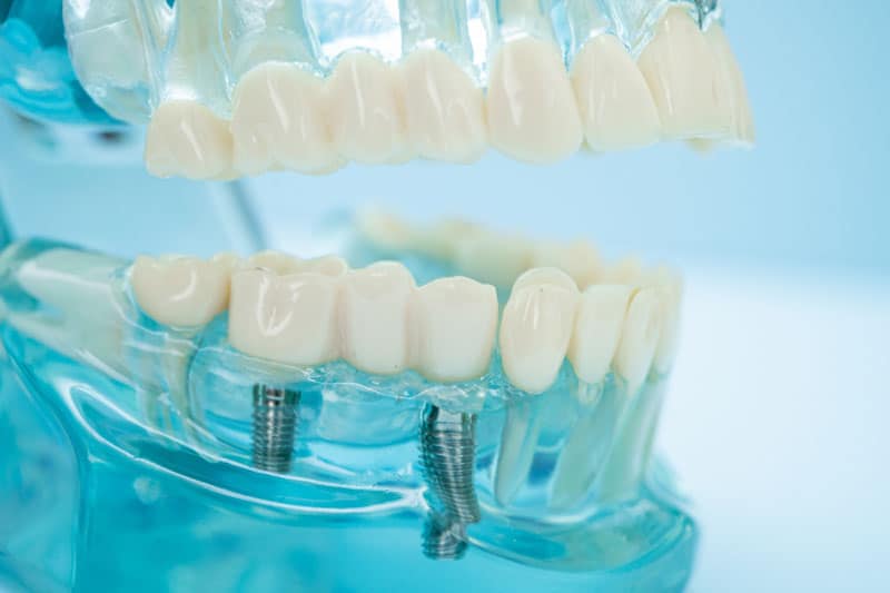 dental implants model, blue jaw model, implant solutions