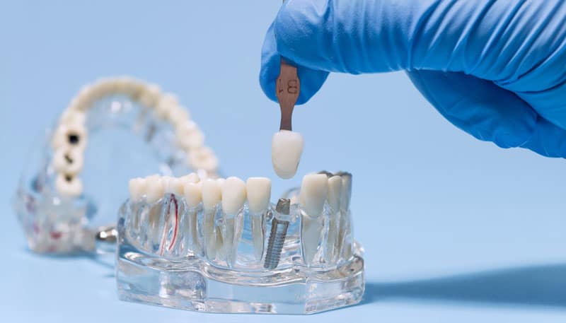 Dental implant color matching with shade guide, blue background dental office, dentist has blue gloves